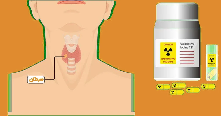 ید درمانی برای سرطان تیروئید چگونه عمل میکند؟