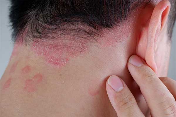 پودر جوانه گندم و درمان مشکلات پوستی مانند اگزما و پسوریازیس